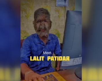 Foto - Hastalığı dünyasını altüst etti! 'Kurt Adam'a dönüştü