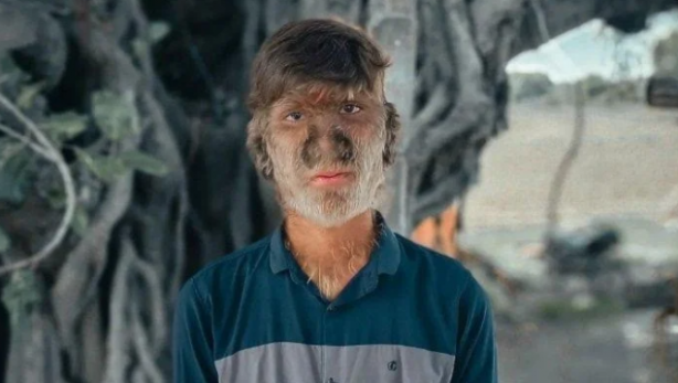 Hastalığı dünyasını altüst etti! 'Kurt Adam'a dönüştü