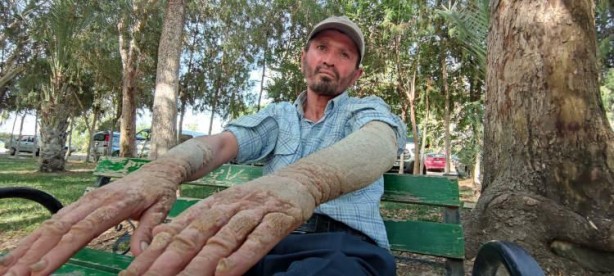 Hastalığı yüzünden insanlar ondan kaçıyor