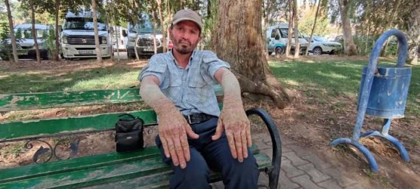 Foto - Hastalığı yüzünden insanlar ondan kaçıyor