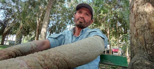 Foto - Hastalığı yüzünden insanlar ondan kaçıyor