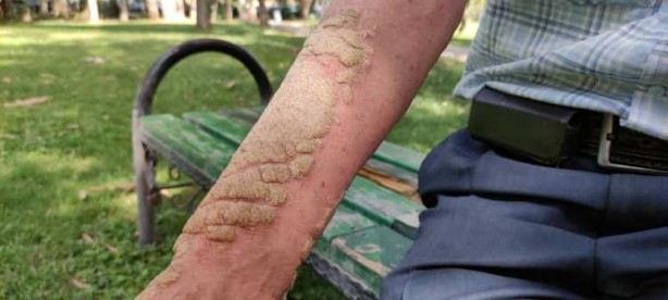 Foto - Hastalığı yüzünden insanlar ondan kaçıyor