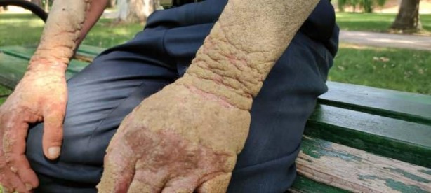 Foto - Hastalığı yüzünden insanlar ondan kaçıyor