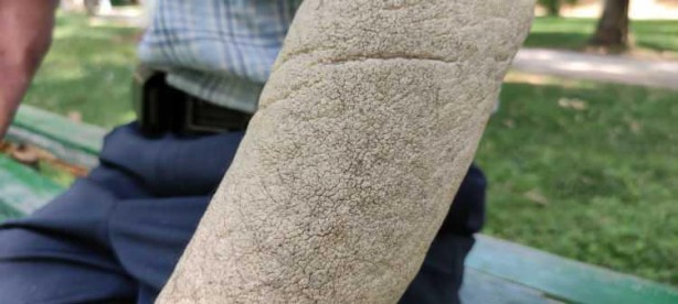 Foto - Hastalığı yüzünden insanlar ondan kaçıyor