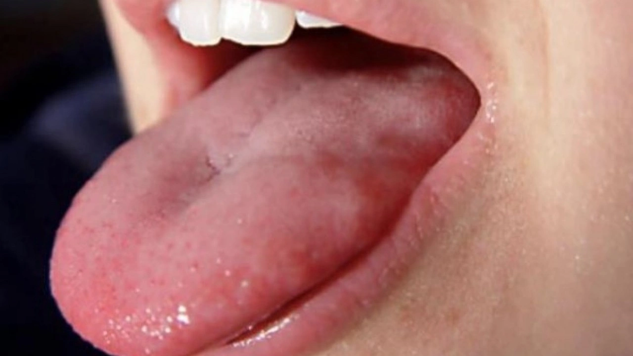 Foto - Hastalığın habercisi! Diliniz bu renkteyse dikkat