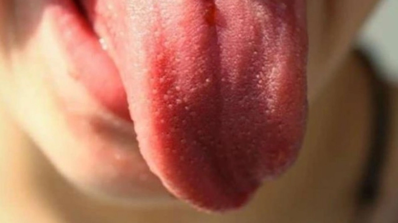 Foto - Hastalığın habercisi! Diliniz bu renkteyse dikkat