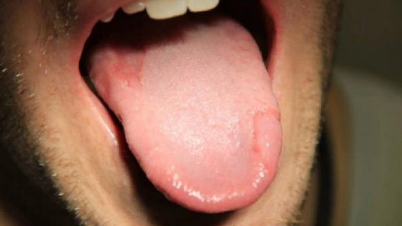 Foto - Hastalığın habercisi! Diliniz bu renkteyse dikkat