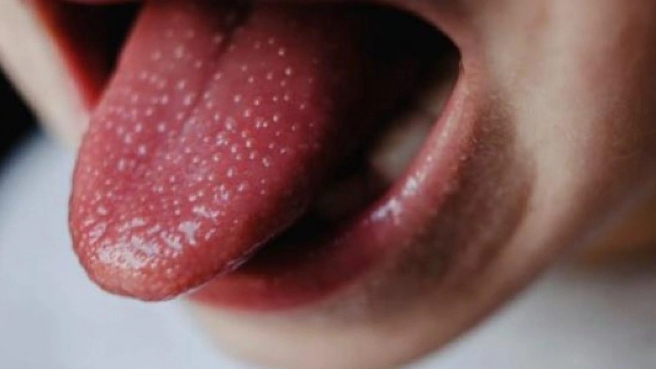 Foto - Hastalığın habercisi! Diliniz bu renkteyse dikkat