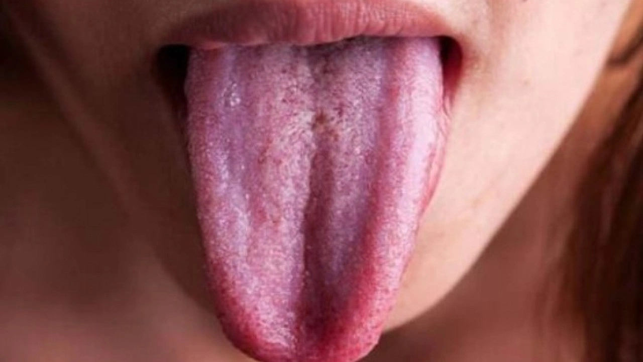 Foto - Hastalığın habercisi! Diliniz bu renkteyse dikkat