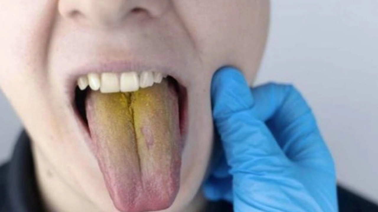 Foto - Hastalığın habercisi! Diliniz bu renkteyse dikkat