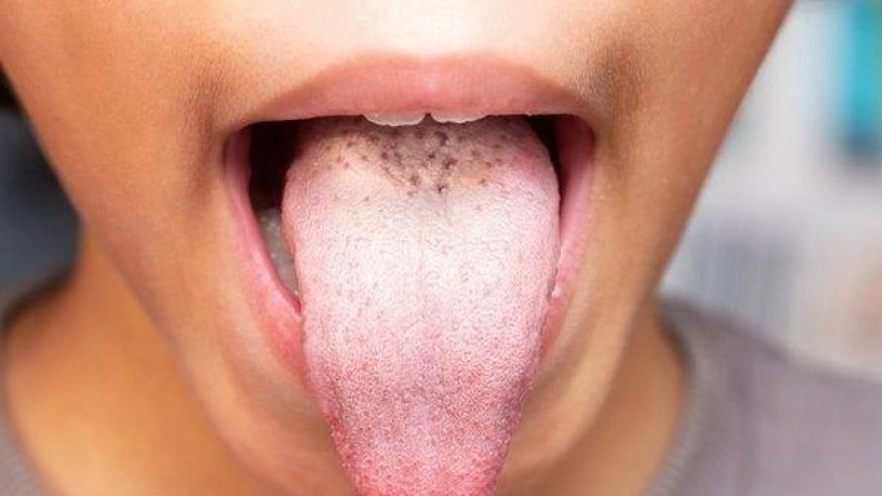 Foto - Hastalığın habercisi! Diliniz bu renkteyse dikkat