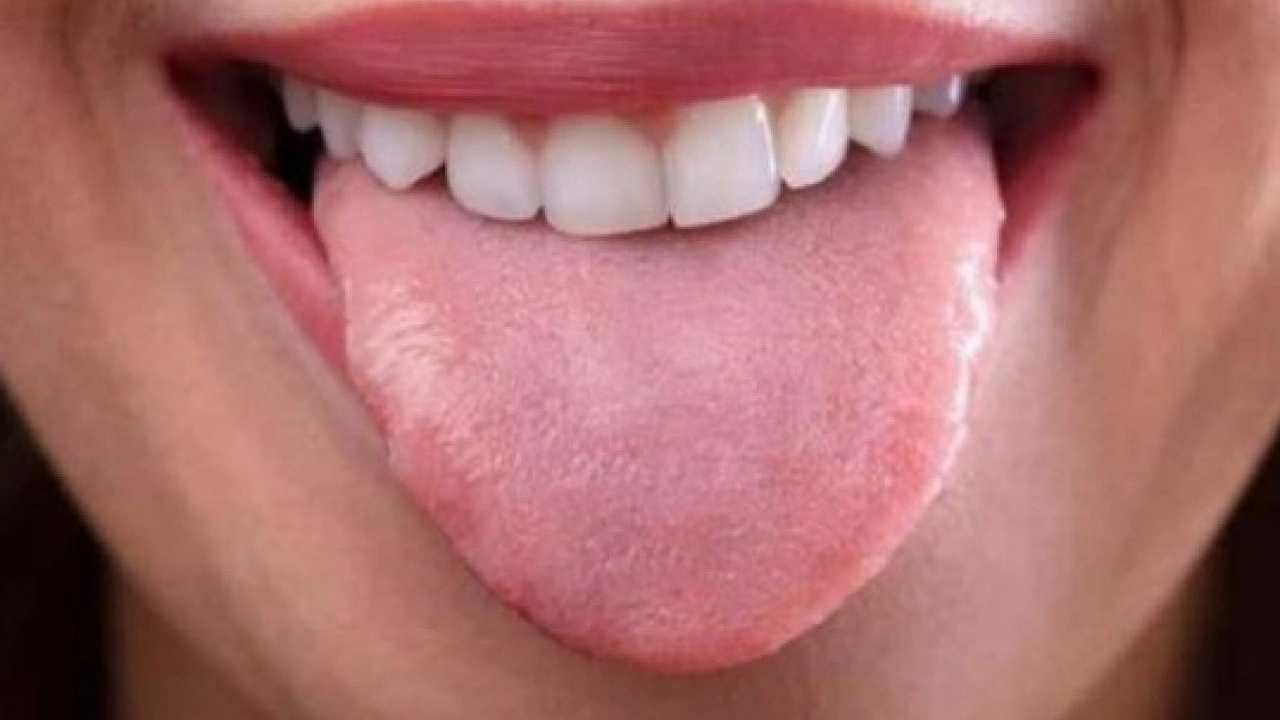 Foto - Hastalığın habercisi! Diliniz bu renkteyse dikkat