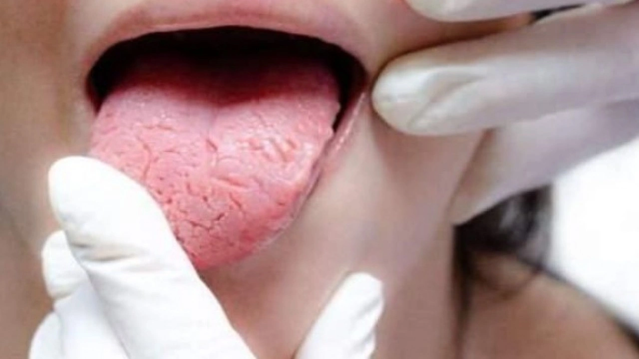 Foto - Hastalığın habercisi! Diliniz bu renkteyse dikkat