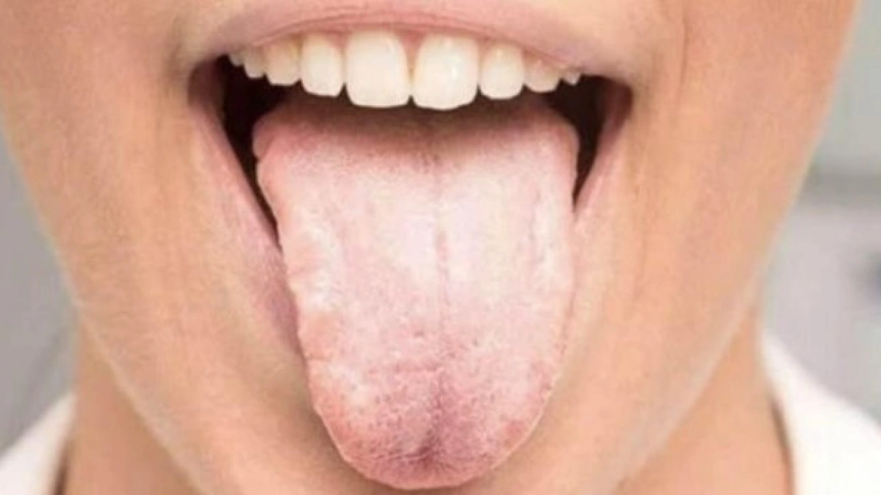 Foto - Hastalığın habercisi! Diliniz bu renkteyse dikkat