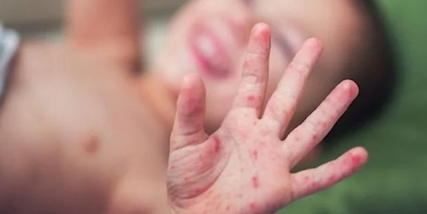 Hastalık bitti derken şimdi de ‘el, ayak ve ağız hastalığı’ hortladı! Uzmanlar neden patladığını açıkladı