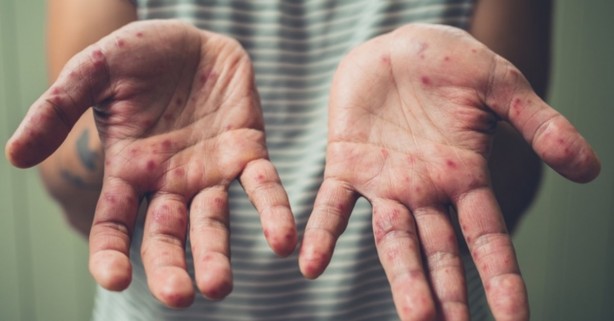 Foto - Hastalık bitti derken şimdi de ‘el, ayak ve ağız hastalığı’ hortladı! Uzmanlar neden patladığını açıkladı