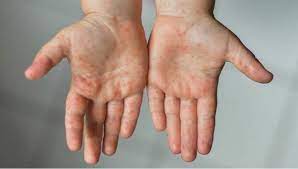 Foto - Hastalık bitti derken şimdi de ‘el, ayak ve ağız hastalığı’ hortladı! Uzmanlar neden patladığını açıkladı