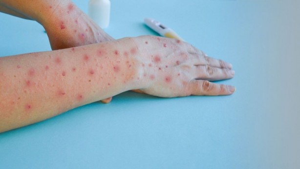 Foto - Hastalık bitti derken şimdi de ‘el, ayak ve ağız hastalığı’ hortladı! Uzmanlar neden patladığını açıkladı