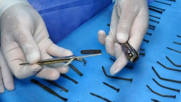 Foto - Hastanın karnından çıkanlara inanamadılar! 