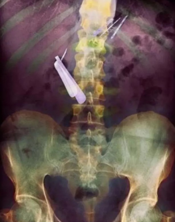 Foto - Hepsi birbirinden korkunç! Doktorları bile şaşkına çeviren görüntüler