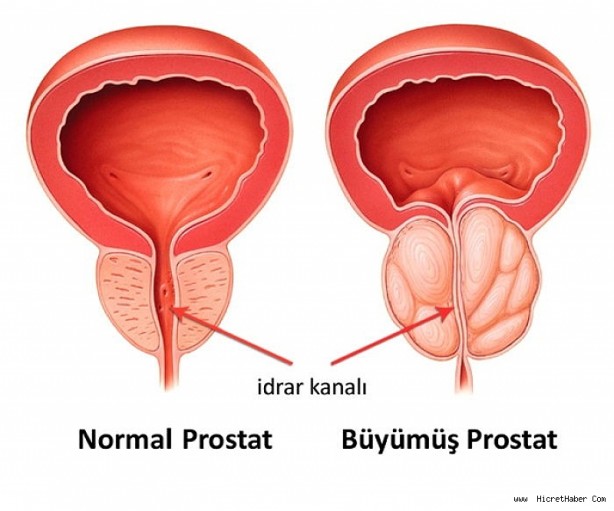 Foto - Her 8 erkekten birinde görülüyor! Ailenizde varsa dikkat, kanser olabilirsiniz