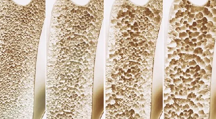 Foto - Her bir kemiği çeliğe dönüştürecek formül! Romatolog önerdi: Kemik erimesini bitiriyor! Duyan hemen almaya başladı