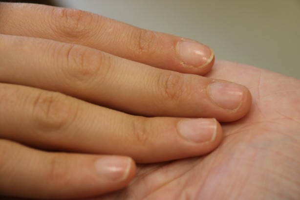 Foto - Hiç kimsenin aklına bile gelmez! Tırnak yeme alışkanlığının sebebi bakın neymiş