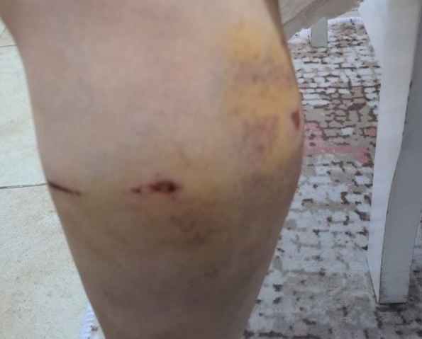 Foto - İBB Başkan Danışmanı Murat Ongun'un köpeği, belediye çalışanını yaraladı! Şikayetçi olan işçi, işten kovuldu