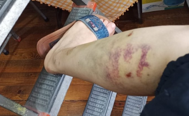 Foto - İBB Başkan Danışmanı Murat Ongun'un köpeği, belediye çalışanını yaraladı! Şikayetçi olan işçi, işten kovuldu