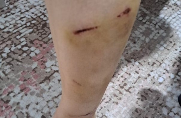 Foto - İBB Başkan Danışmanı Murat Ongun'un köpeği, belediye çalışanını yaraladı! Şikayetçi olan işçi, işten kovuldu