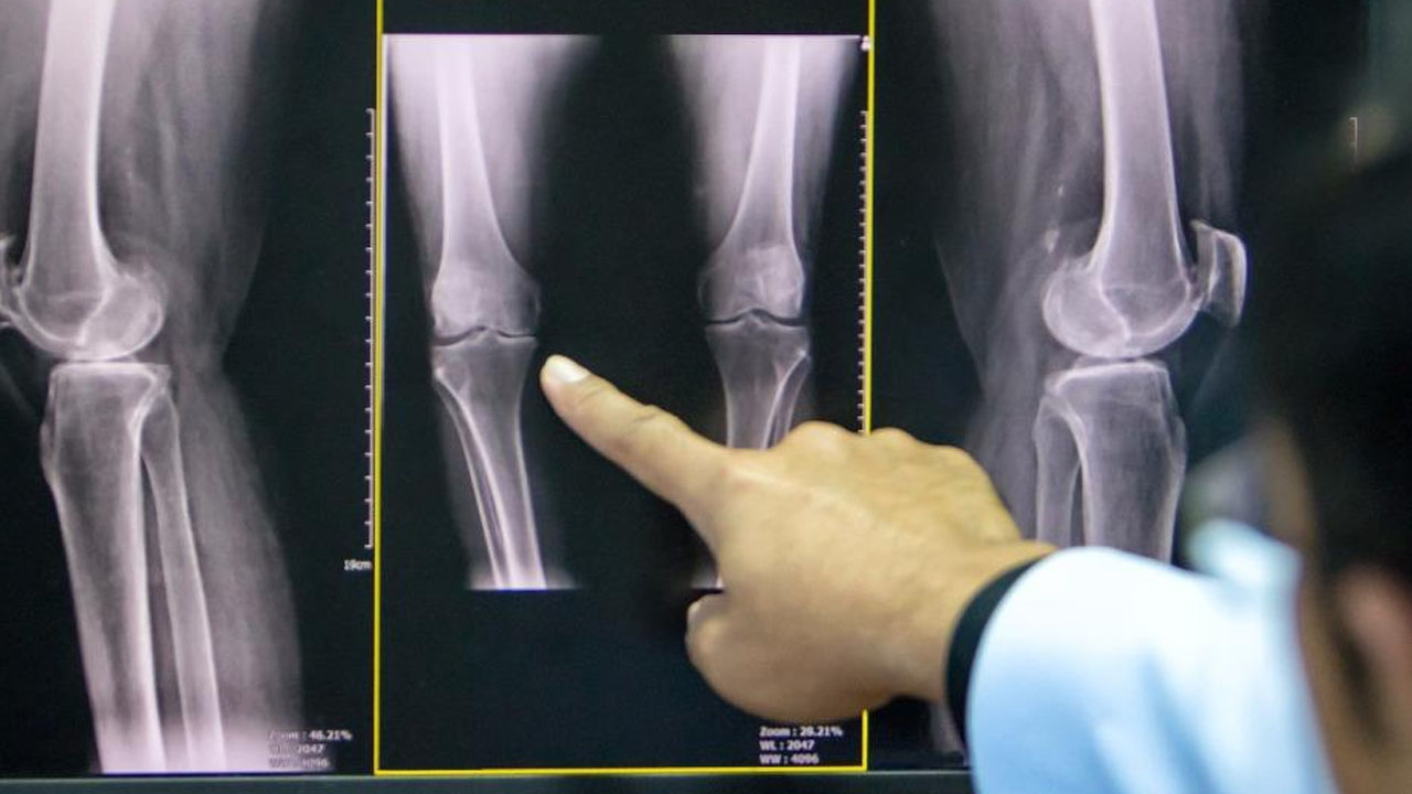 Foto - İbrahim Saraçoğlu tarifini verdi: Tıkalı bağırsakları anında boşaltıyor! Kemikleri betona çeviriyor!