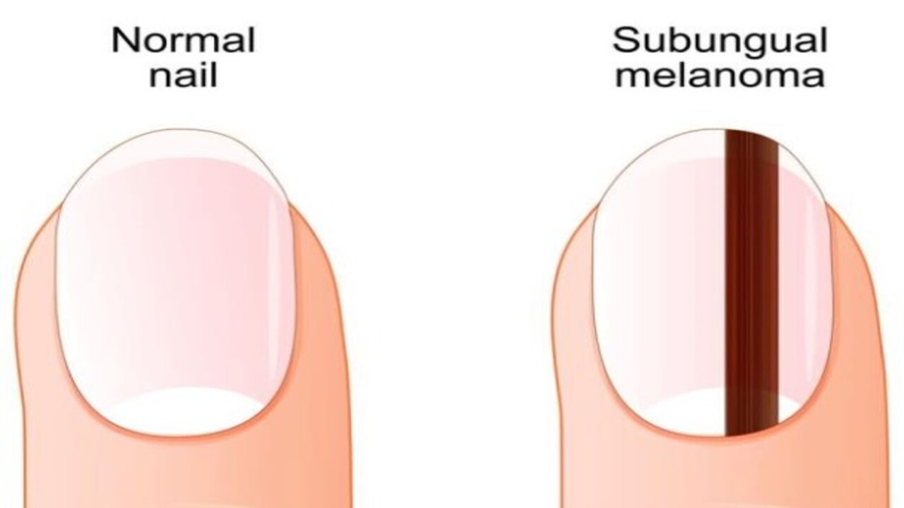 Foto - İç organlara yayılma riski var! Tırnak üzerindeki bu leke neyin habercisi