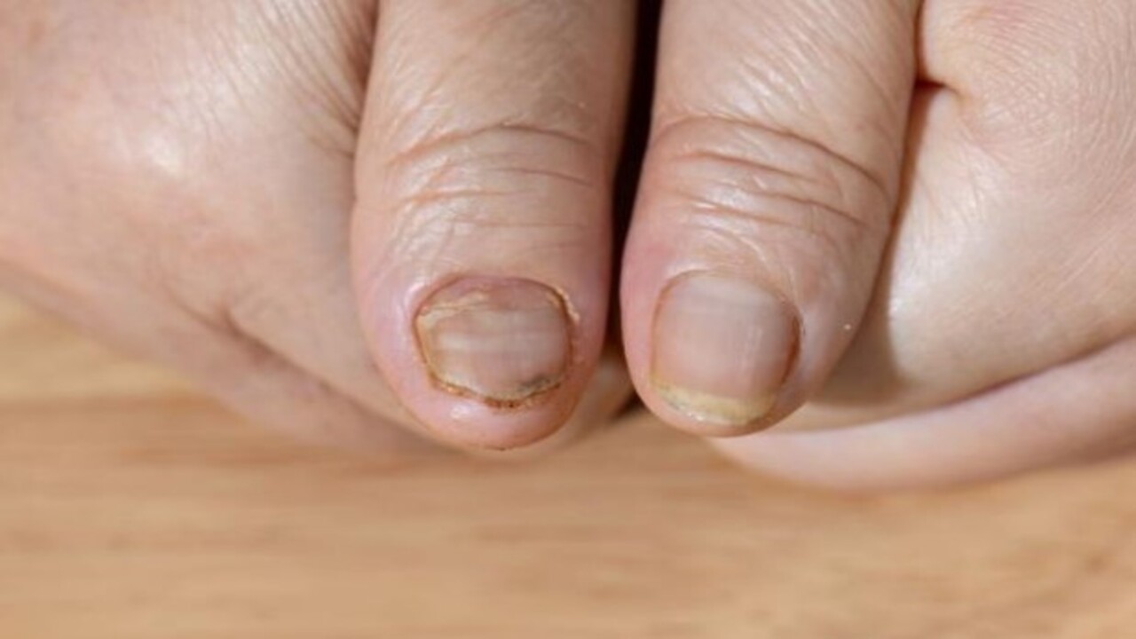 Foto - İç organlara yayılma riski var! Tırnak üzerindeki bu leke neyin habercisi