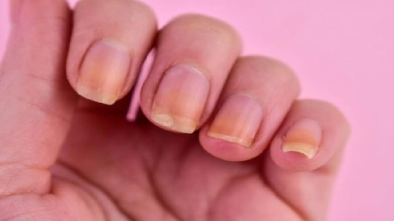 Foto - İç organlara yayılma riski var! Tırnak üzerindeki bu leke neyin habercisi