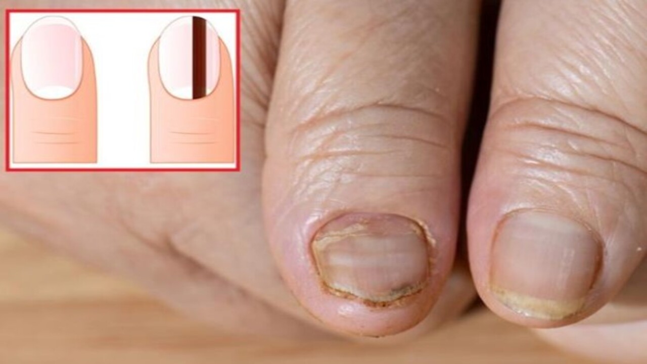 İç organlara yayılma riski var! Tırnak üzerindeki bu leke neyin habercisi