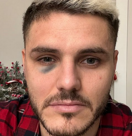 Foto - Icardi'nin son hali herkesi şok içerisinde bıraktı... Dzeko açtı ağzını yumdu gözünü...