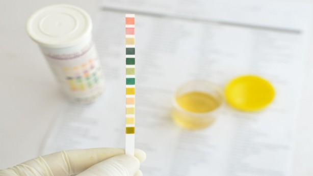 İdrar renginiz böbrek sağlığınız hakkında bilgi veriyor