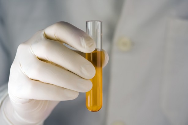 Foto - İdrarınızın rengi böyleyse dikkat