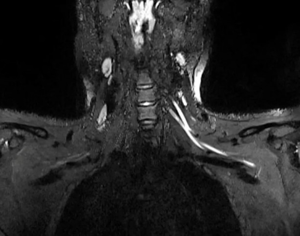 Foto - İlk kez görüntülendi! Korona neden ağrı yapıyor