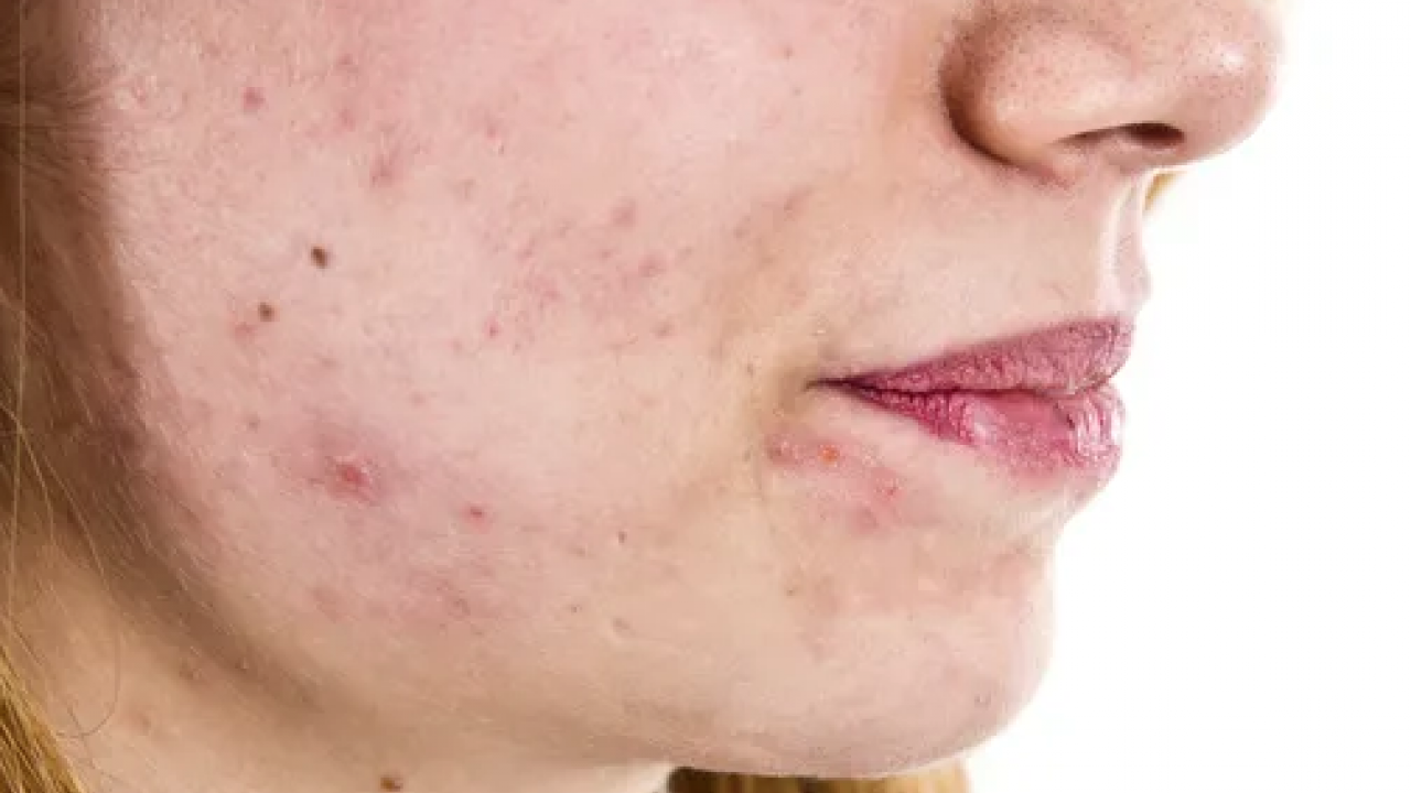 İltihaplı sivilceyi anında eritip yok ediyor! Asit gibi etkisi var, 1 damlası sivilceyi kurutuyor