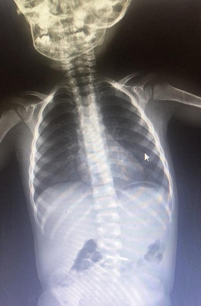 Foto - İnanılır gibi değil! Bakın 2 yaşındaki çocuk ne yuttu