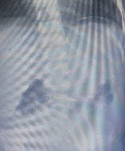 Foto - İnanılır gibi değil! Bakın 2 yaşındaki çocuk ne yuttu