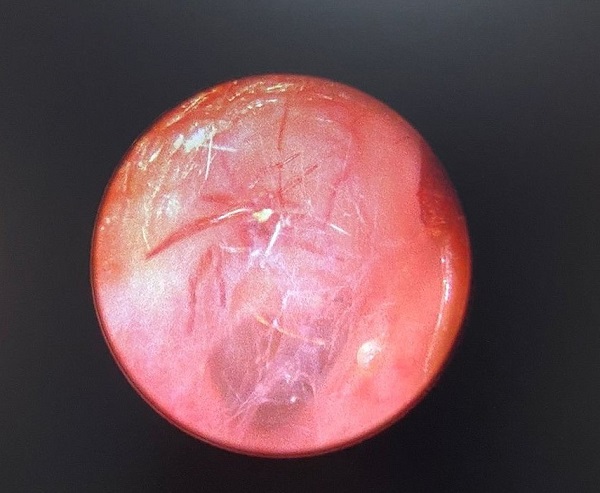 Foto - İnanılır gibi değil! Bakın yaşlı kadının kulağından ne çıktı