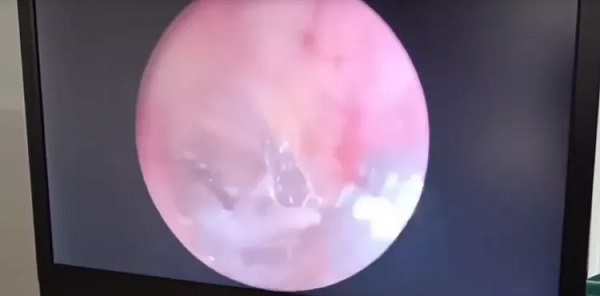 Foto - İnanılır gibi değil | Kadının kulağından öyle bir şey çıktı ki! 