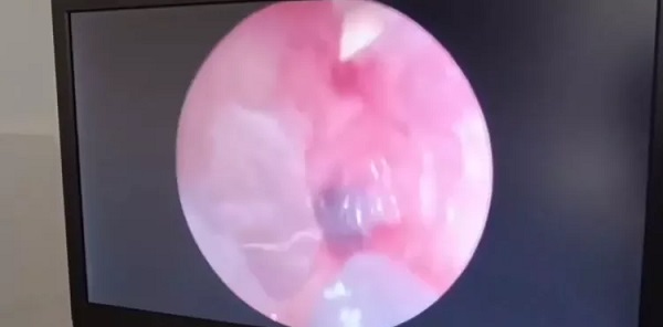 Foto - İnanılır gibi değil | Kadının kulağından öyle bir şey çıktı ki! 