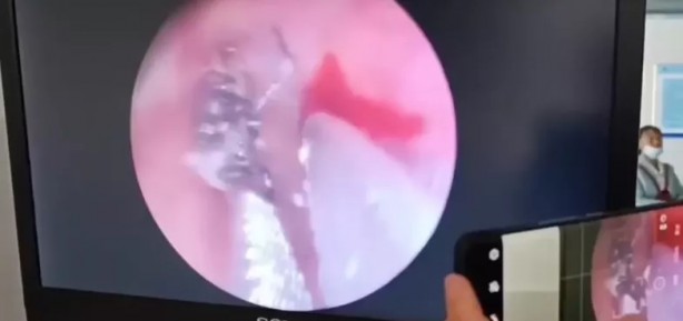 Foto - İnanılır gibi değil | Kadının kulağından öyle bir şey çıktı ki! 