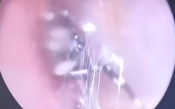 Foto - İnanılır gibi değil | Kadının kulağından öyle bir şey çıktı ki! 