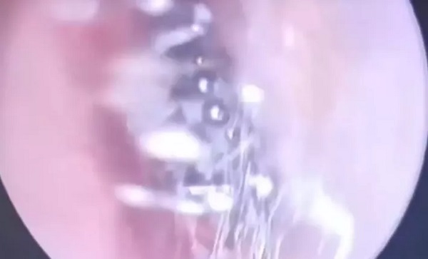 Foto - İnanılır gibi değil | Kadının kulağından öyle bir şey çıktı ki! 