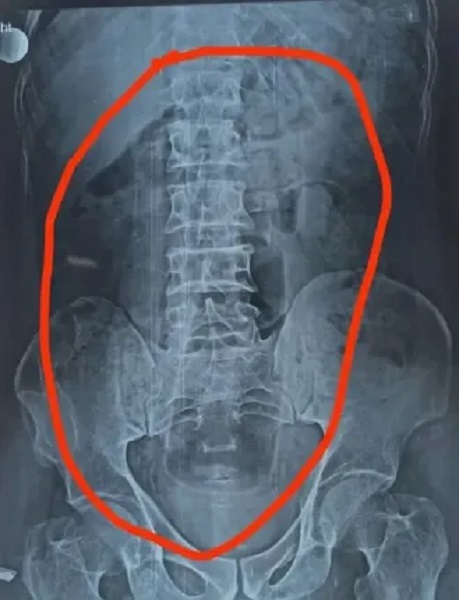 Foto - İnanılmaz bir olay yaşandı | Hastanın midesinden öyle bir şey çıktı ki! 