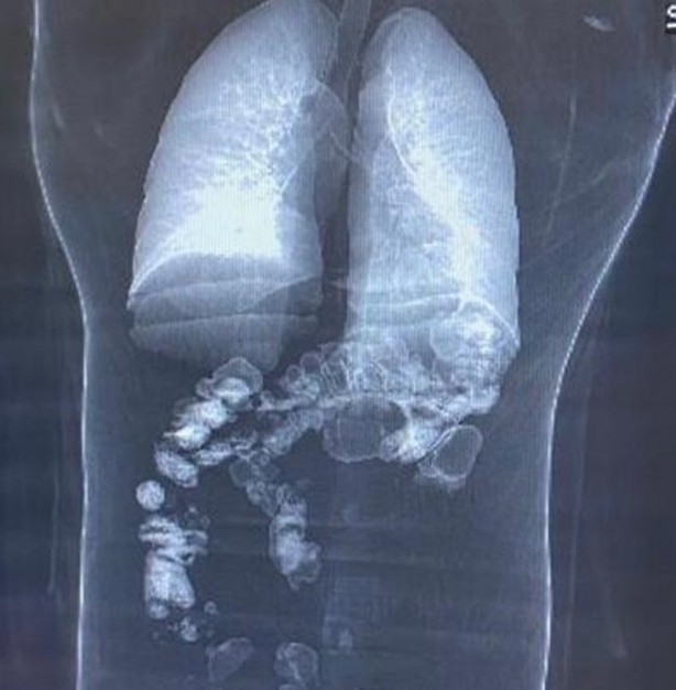 Foto - İnanılmaz görüntüler! Mide ve bağırsaklarında uyuşturucu ile böyle yakalandılar